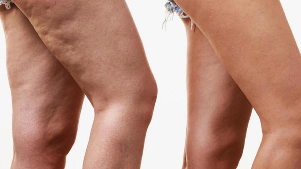 Lipödem Hakkında Bilmeniz Gerekenler